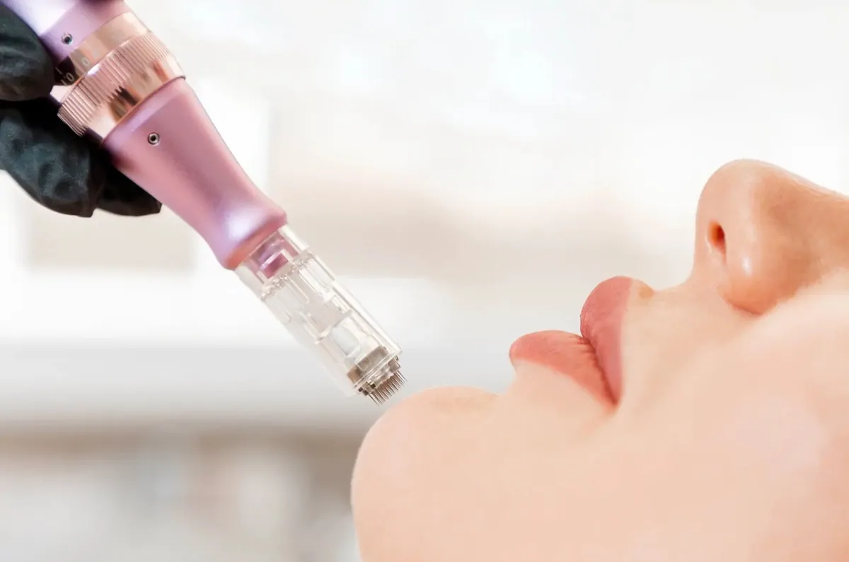 Microneedling mit Radiofrequenz – Behandlung im Kosmetikstudio Beate Hornaff Ludwigsburg